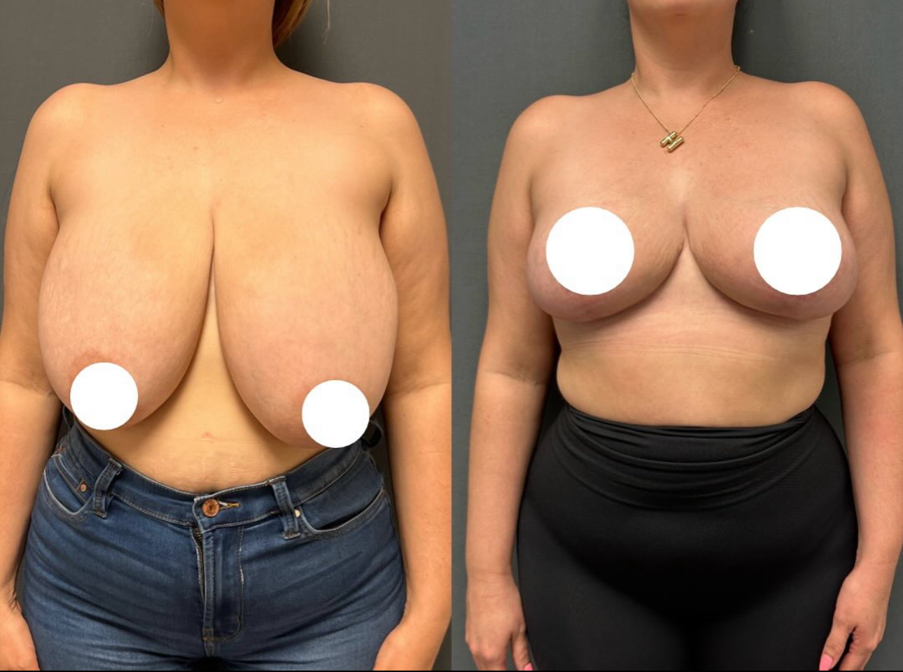 Before and After Image: Breast Lift - front