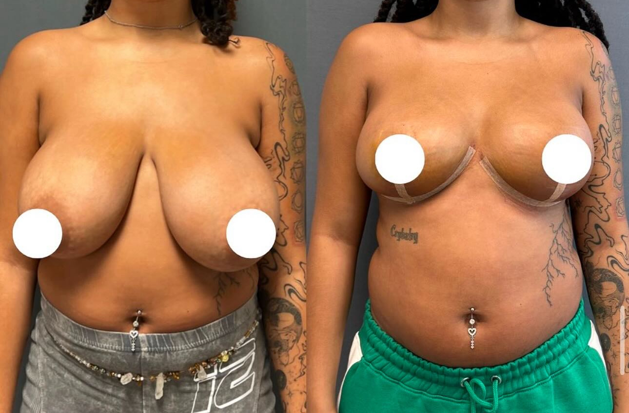 Before and After Image: Breast Lift - front