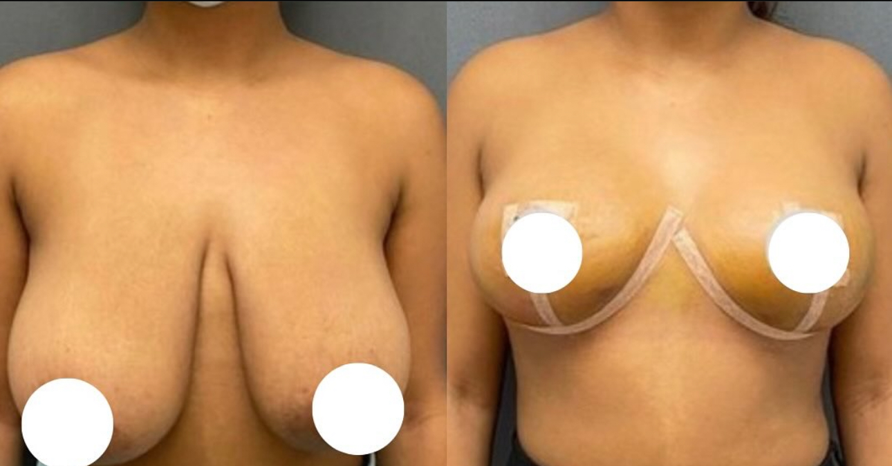 Before and After Image: Breast Lift - front