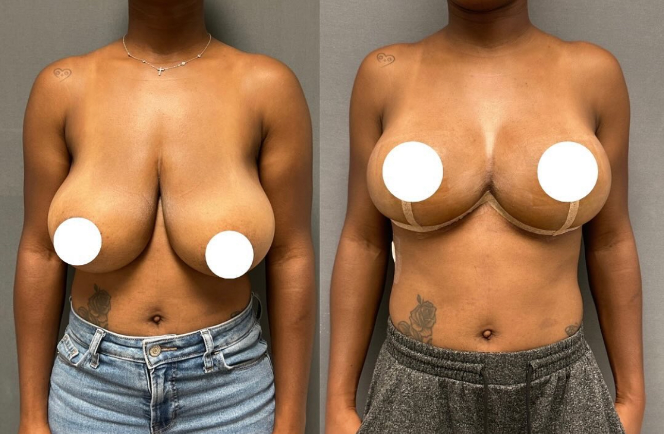 Before and After Image: Breast Lift - front
