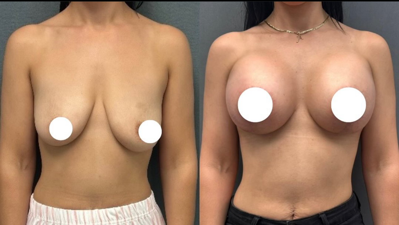 Before and After Image: Breast Lift with Implants - front