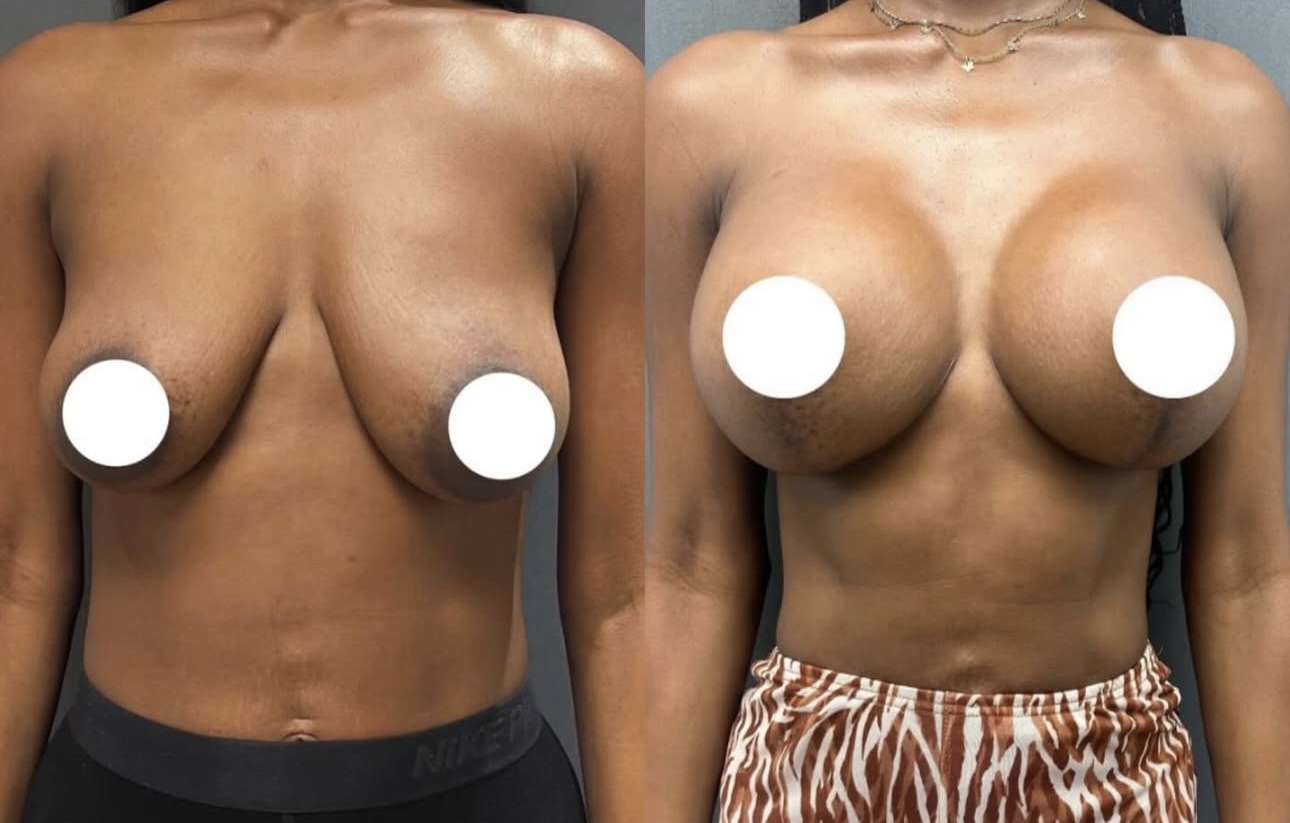 Before and After Image: Breast Lift with Implants - front