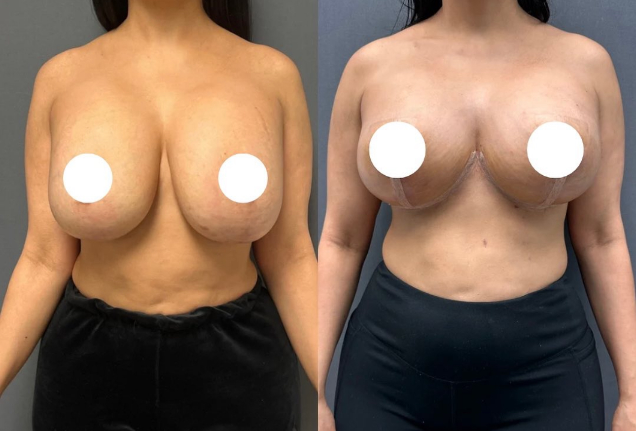 Before and After Image: Breast Lift with Implants - front