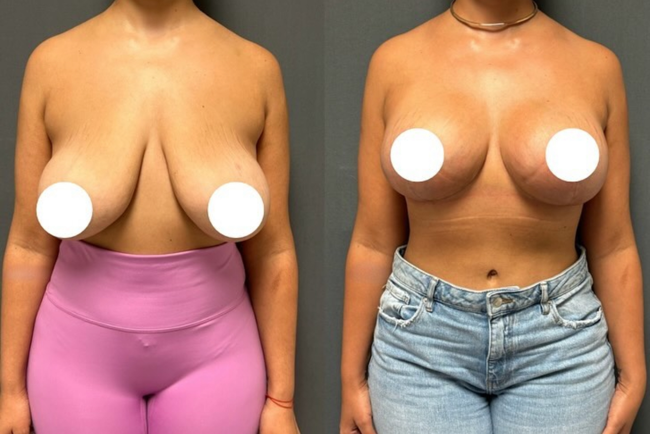 Before and After Image: Breast Lift with Implants - front