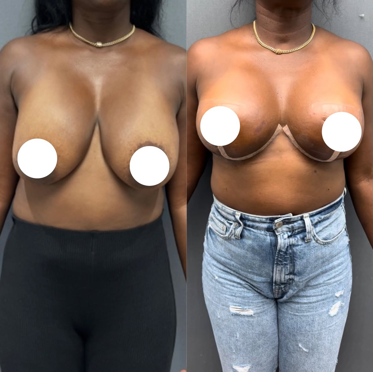 Before and After Image: Breast Lift with Implants - front