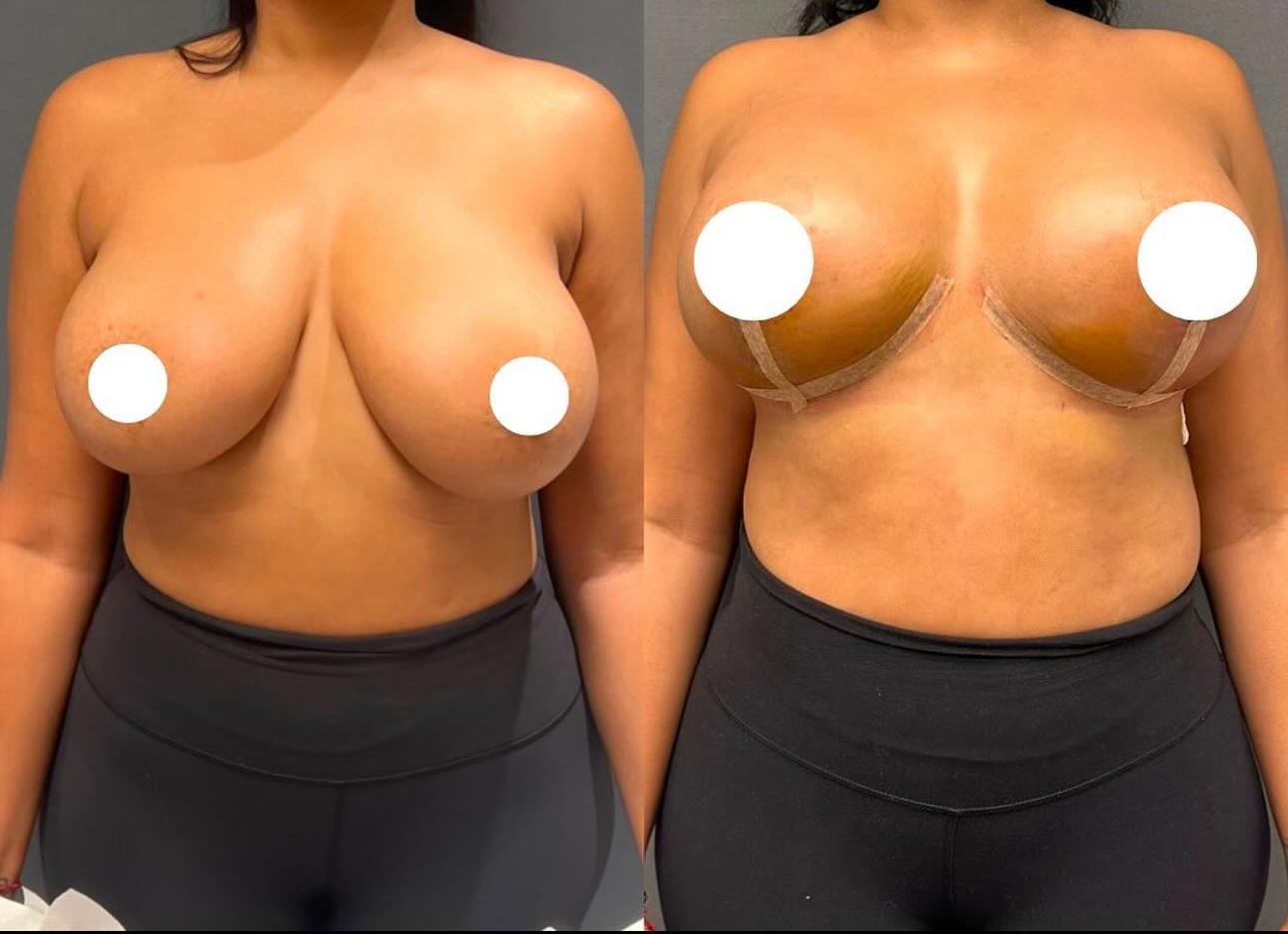 Before and After Image: Breast Lift with Implants - front