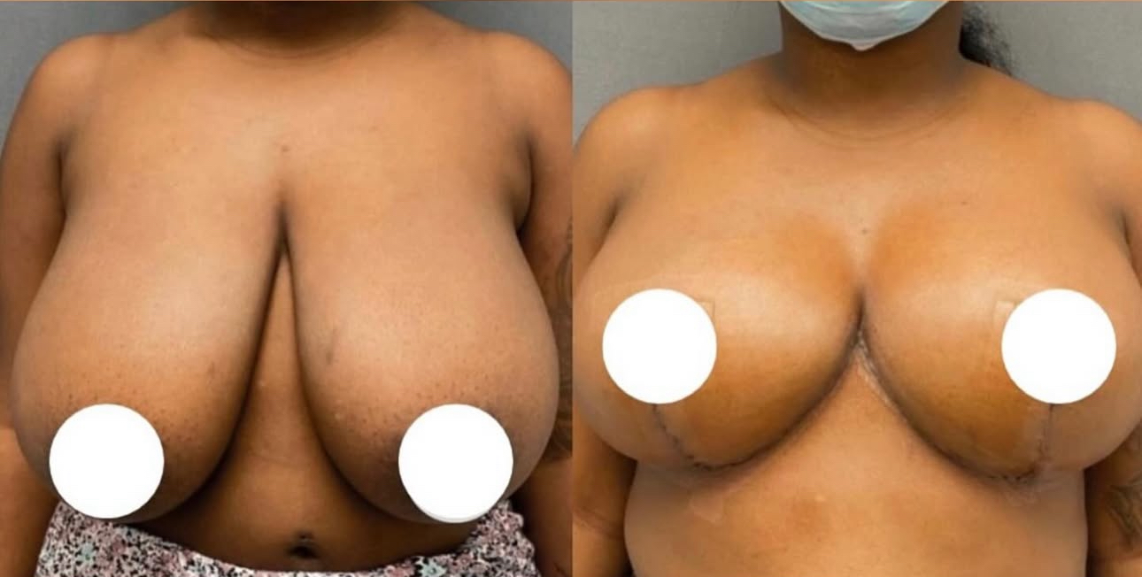 Before and After Image: Breast Lift - front